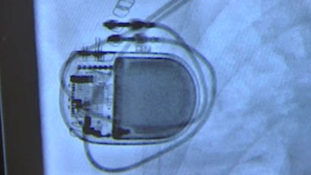 MRIsafe pacemakers a big advancement for cardiovascular health