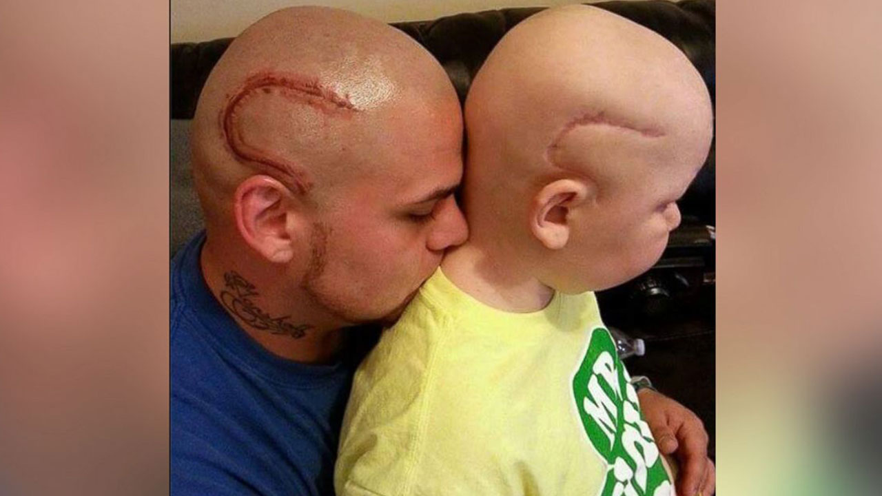 Dad gets tattoo to match son's surgery scar