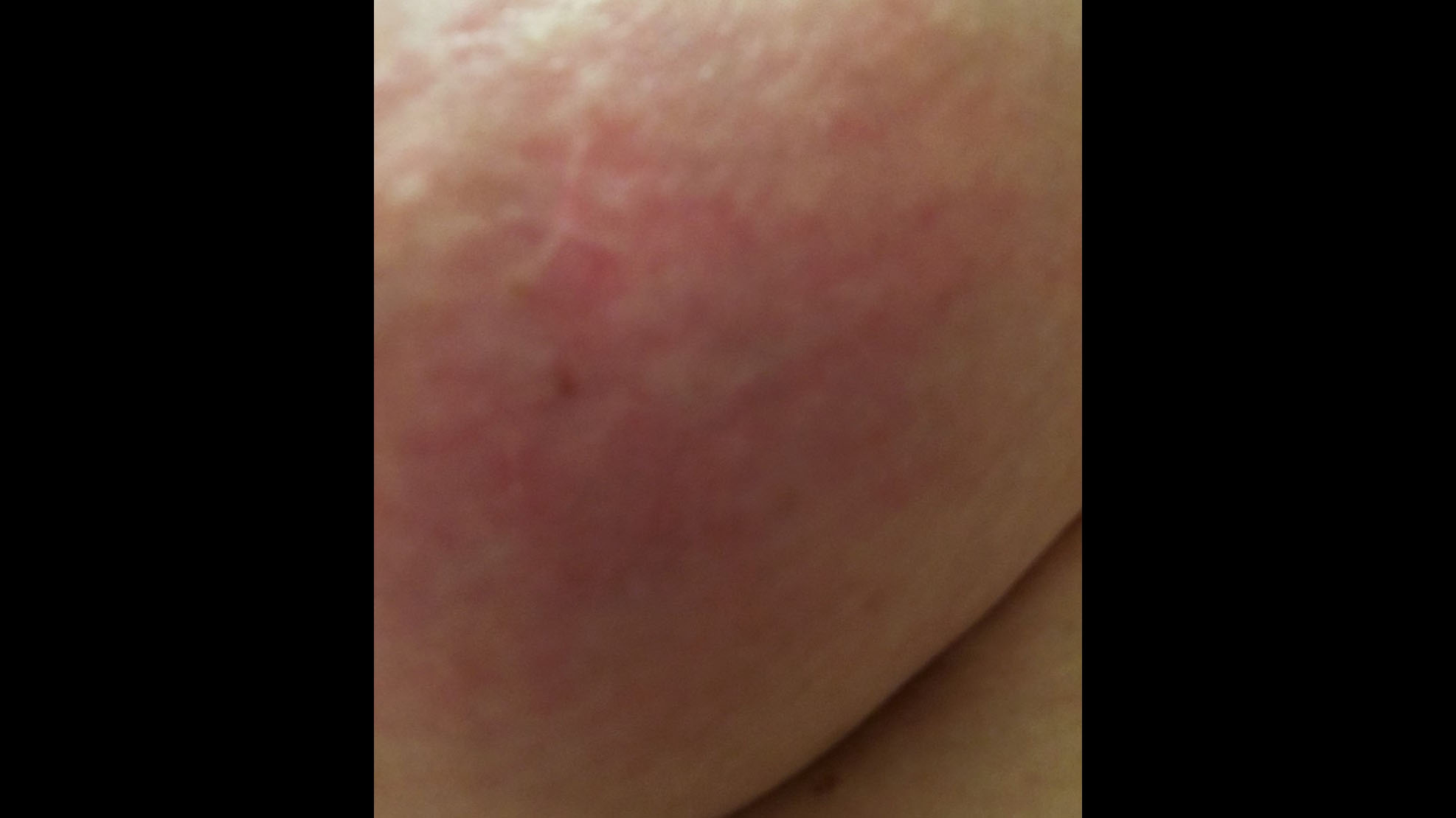Red circle under breast. Slight burning. Been here for 3 days. :  r/DermatologyQuestions