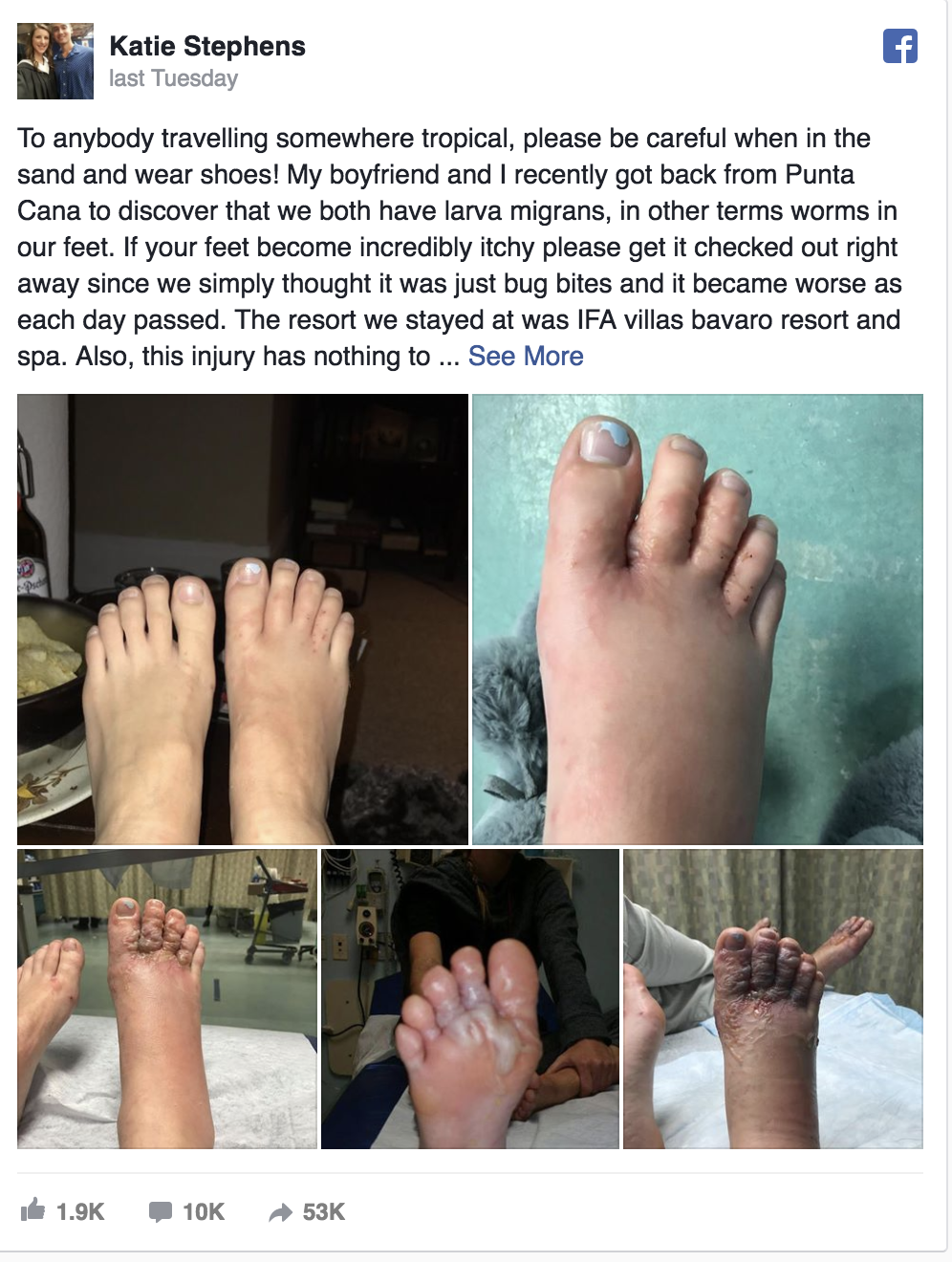 Couple contract parasitic hookworm in feet after walking on Punta